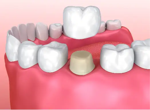 Dental Crowns & Bridges